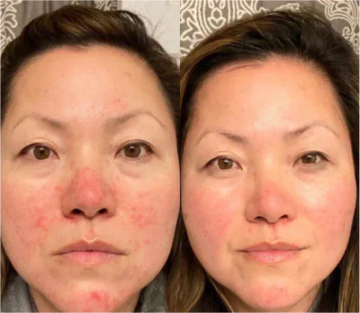 EMS Micro-Current Eye Massager